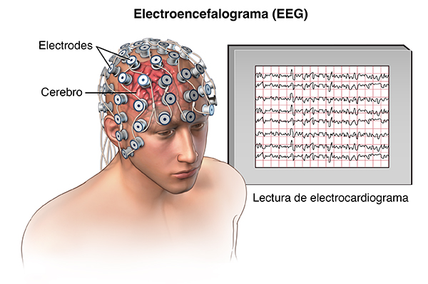 Impulsos eléctricos anormales durante un ataque